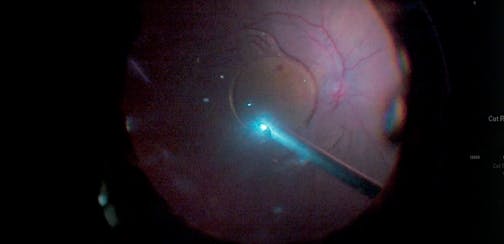 Removal of PCIOL on the Macula