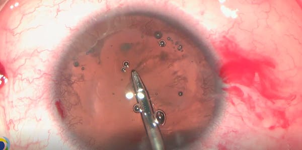 Phacoemulsification, PCIOL, and Artificial Iris Implantation thumbnail