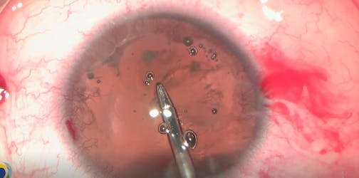 Phacoemulsification, PCIOL, and Artificial Iris Implantation