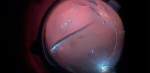 PPV for Retinal Detachment With Giant Retinal Tear thumbnail