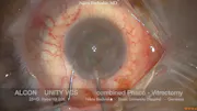 Unity VCS – 4D Phaco & Intelligent Fluidics