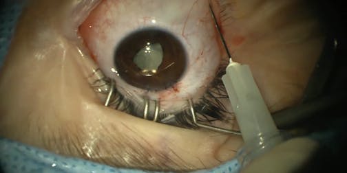 Complicated Case of Dislocated IOL