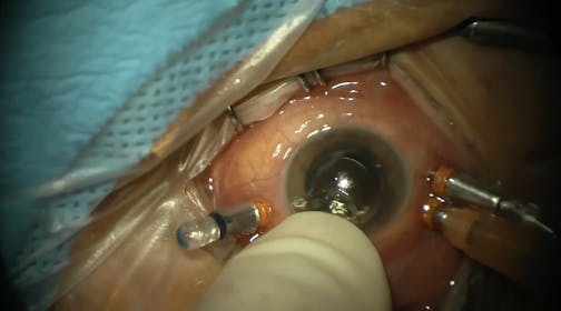 Retinal Detachment in the Presence of Malignant Melanoma