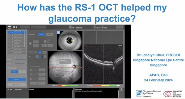 How Has the RS-1 OCT Helped My Glaucoma Practice? thumbnail