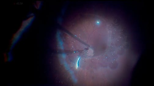 Minimally Invasive Vitrectomy for Phakic Retinal Detachment With Peripheral Retinotomy