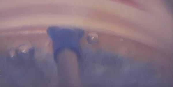 Streamline Surgical System Handpiece thumbnail