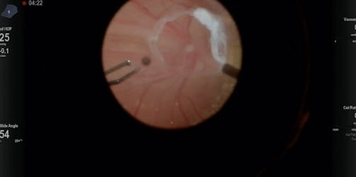Familial Exudative Vitreoretinopathy