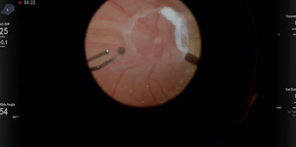 Familial Exudative Vitreoretinopathy thumbnail