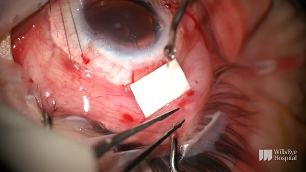Tube Shunt Implantation Following Keratolimbal Graft thumbnail