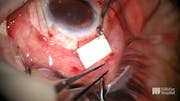 Tube Shunt Implantation Following Keratolimbal Graft