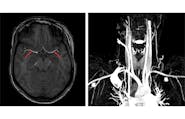 Ischemic Complications from a Facial Lipofilling Procedure image