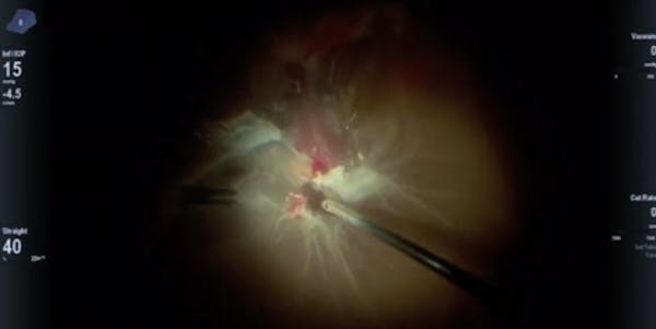TRD and Focal Retinectomy thumbnail