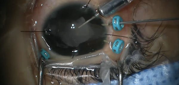 Coats Disease Stage-4 Detachment thumbnail