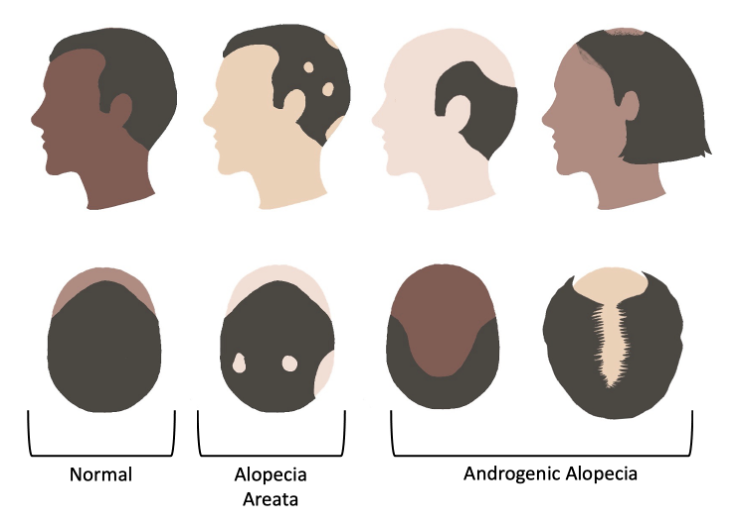 Early diagnosis, treatment key to prevent permanent baldness in