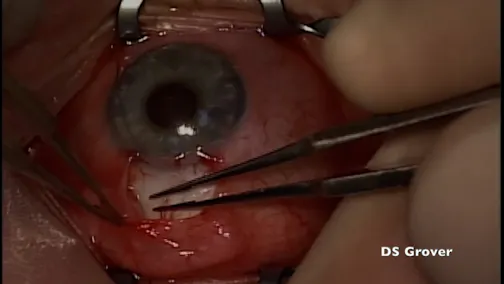 Implantation of a MicroShunt
