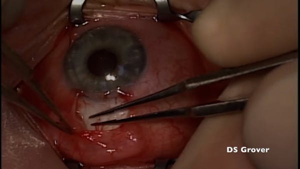 Implantation of a Preserflo Microshunt thumbnail