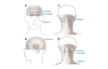 Trigger Point Injections for Headache and Migraine - Neurology Specialists