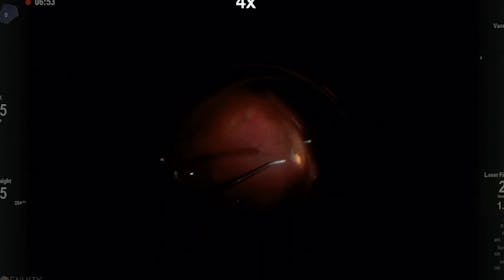 Retinal Detachment Repair