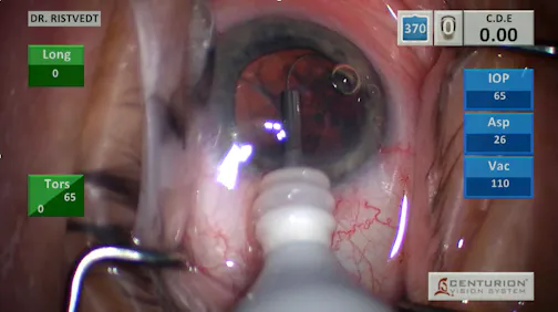 miLoop for Brunescent Cataract