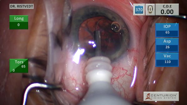 miLoop for Brunescent Cataract thumbnail