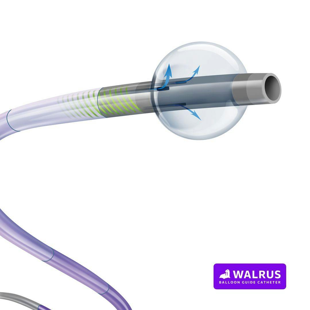 Q’Apel’s Walrus Balloon Guide Catheter Gains CE Mark Approval