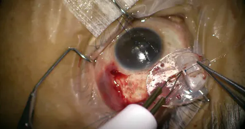 Attaching Ahmed Glaucoma Valve to the Sclera
