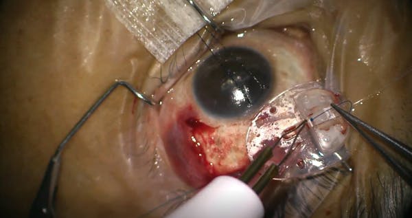 Attaching Ahmed Glaucoma Valve to the Sclera thumbnail
