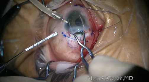 Fixation of Iris-IOL Complex in an Aphakic Patient With Iris Defect