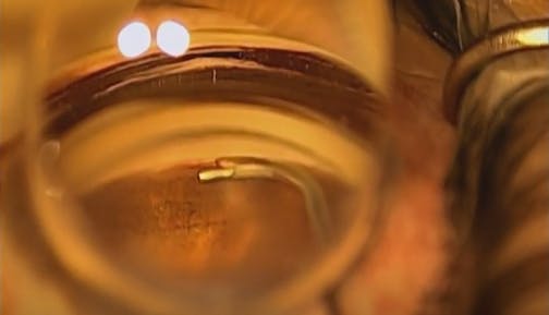 Hydrus Microstent Placement Tips
