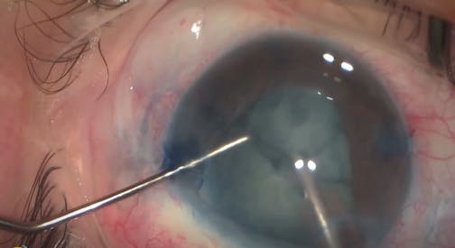 DSAEK With Phacoemulsification and PC-IOL Implantation
