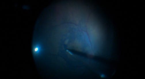 ILM Peeling With Scraper in a Case of Macular Hole
