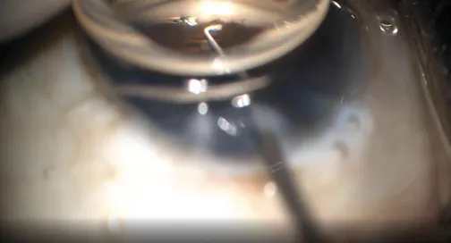Refractive Lensectomy With Hydrus Implantation