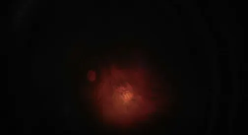 Bilateral Macular Foveoschisis