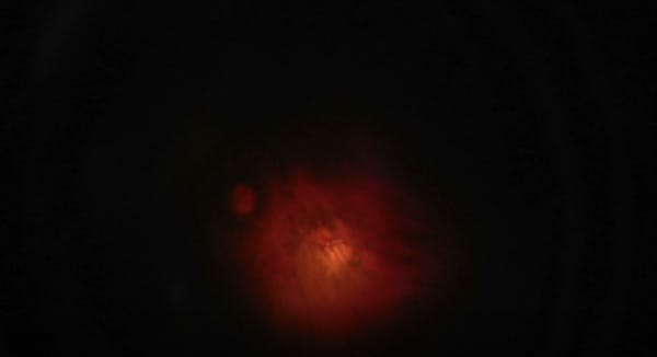 Bilateral Macular Foveoschisis thumbnail
