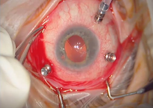 Iris Claw IOL Rescue After Blunt Trauma