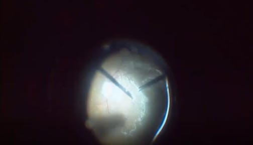 Shallow Retinal Detachment Without Visible Rupture