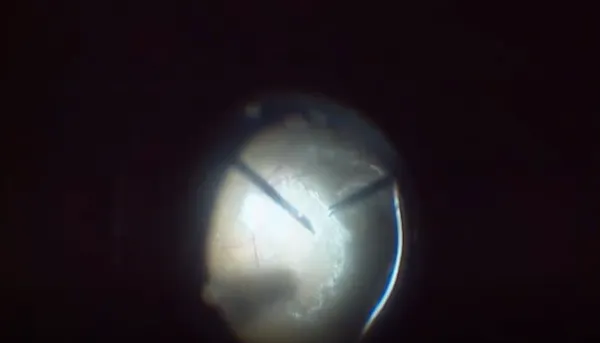 Shallow Retinal Detachment Without Visible Rupture thumbnail