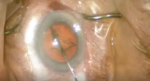 DIY 27-Gauge Chopper Cannula