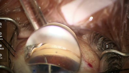 The Power of Two Microstents