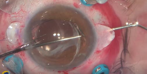 Rescued IOL CTR-Bag Complex