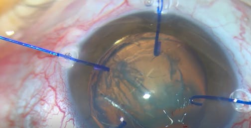 Canabrava Double-Flanged Technique