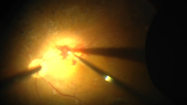 Hyaloid Removal in Diabetic Vitrectomy thumbnail