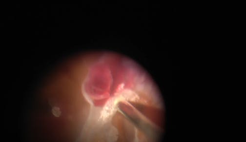 Hybrid Vitrectomy in Diabetic Tractional Retinal Detachment