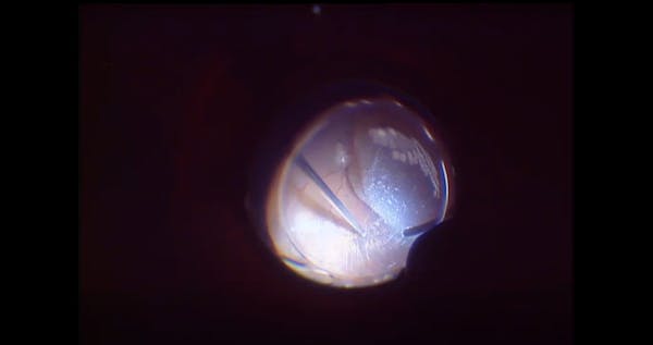 Macular Hole Related to Retinal Detachment thumbnail