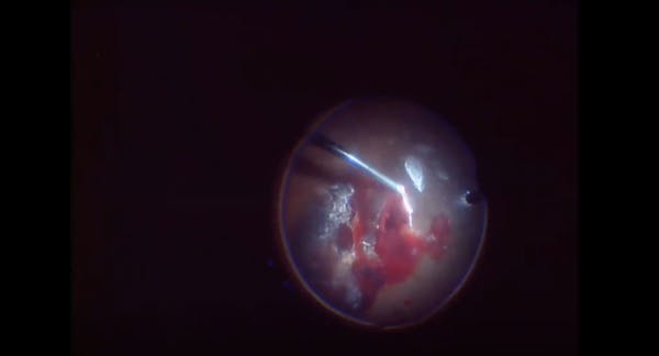 Large Retrohyaloid Hematoma in PDR thumbnail