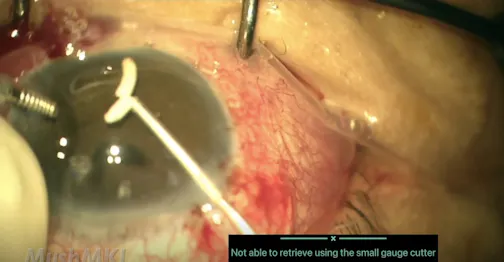 Removal of Anterior Dislocated Ozurdex (Viscoelastic Assisted)