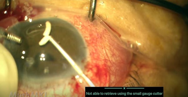 Removal of Anterior Dislocated Ozurdex (Viscoelastic Assisted) thumbnail