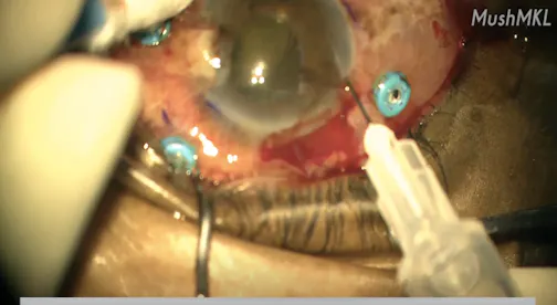 AC Tap in a Pseudophakic Eye