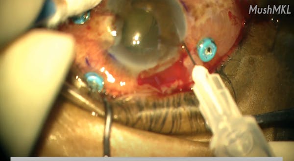 AC Tap in a Pseudophakic Eye thumbnail