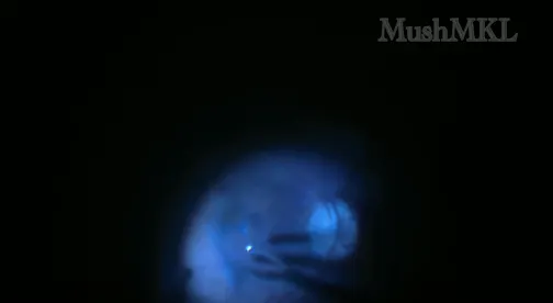Peripheral Induction of PVD and Peeling of ERM/ILM